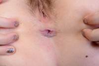 ATK hairy  in young and hairy