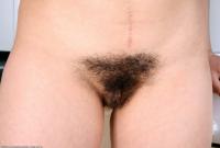ATK hairy  in mature and hairy