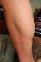 ATK hairy  in mature and hairy