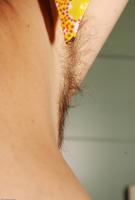 ATK hairy  in mature and hairy