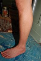 ATK hairy  in mature and hairy