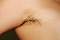 ATK hairy  in mature and hairy