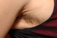 ATK hairy  in mature and hairy