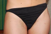ATK hairy  in mature and hairy