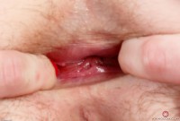 ATK hairy  in young and hairy