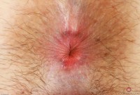 ATK hairy  in young and hairy