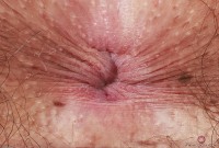 ATK hairy  in young and hairy