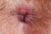 ATK hairy  in young and hairy