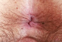 ATK hairy  in young and hairy