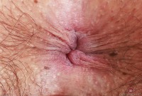 ATK hairy  in young and hairy