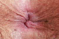 ATK hairy  in young and hairy