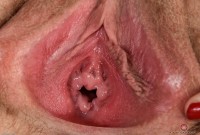 ATK hairy  in young and hairy