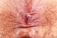 ATK hairy  in young and hairy