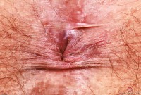 ATK hairy  in young and hairy