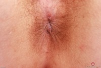 ATK hairy  in young and hairy