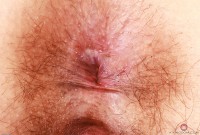 ATK hairy  in young and hairy