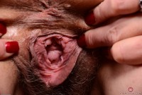 ATK hairy  in mature and hairy