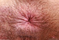 ATK hairy  in mature and hairy