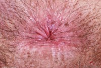 ATK hairy  in mature and hairy