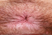 ATK hairy  in mature and hairy