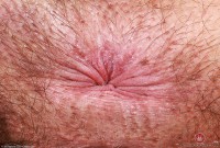 ATK hairy  in mature and hairy