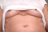 ATK hairy  in mature and hairy