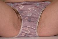 ATK hairy  in mature and hairy