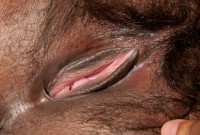 ATK hairy  in mature and hairy