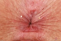 ATK hairy  in young and hairy