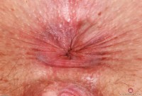 ATK hairy  in young and hairy