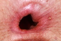 ATK hairy  in young and hairy