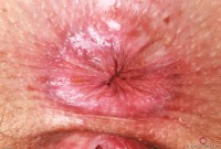 ATK hairy  in young and hairy