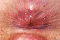 ATK hairy  in young and hairy