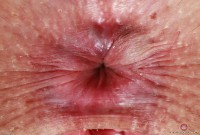 ATK hairy  in young and hairy