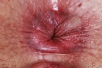 ATK hairy  in young and hairy