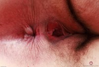 ATK hairy  in young and hairy