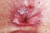 ATK hairy  in young and hairy