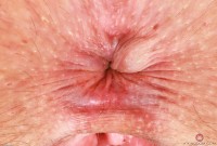 ATK hairy  in young and hairy
