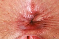 ATK hairy  in young and hairy