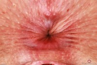 ATK hairy  in young and hairy