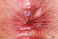 ATK hairy  in mature and hairy