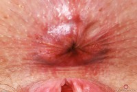 ATK hairy  in mature and hairy