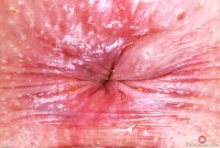 ATK hairy  in mature and hairy