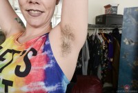 ATK hairy  in mature and hairy