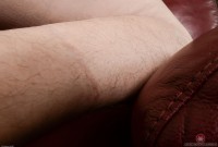 ATK hairy  in mature and hairy