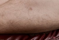 ATK hairy  in mature and hairy