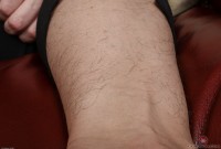 ATK hairy  in mature and hairy