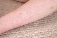 ATK hairy  in young and hairy