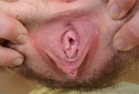 ATK hairy  in young and hairy