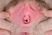ATK hairy  in young and hairy